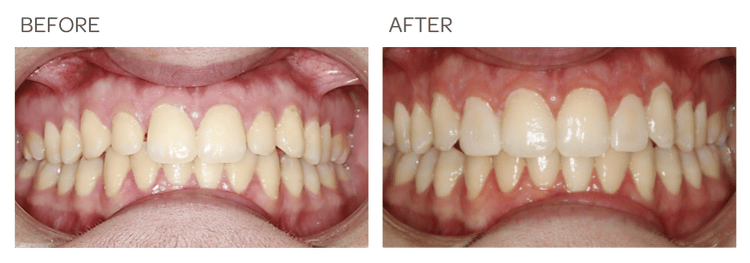 2 Porcelain Veneers on lateral incisors - SIA Dental