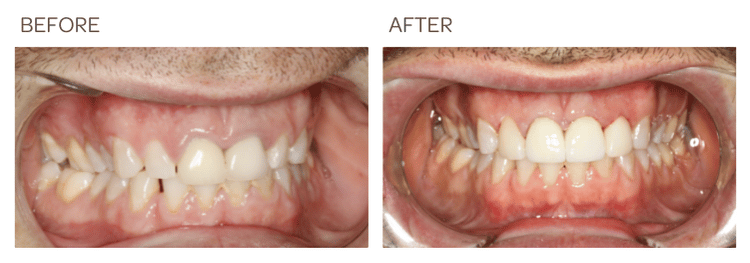 Crown Lengthening Surgery and New Crowns. Teeth are endodontically treated - SIA Dental Essendon