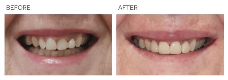 Crowns and Veneers - SIA Dental