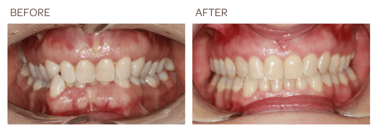 Invisalign to correct deep overbite for 1 year