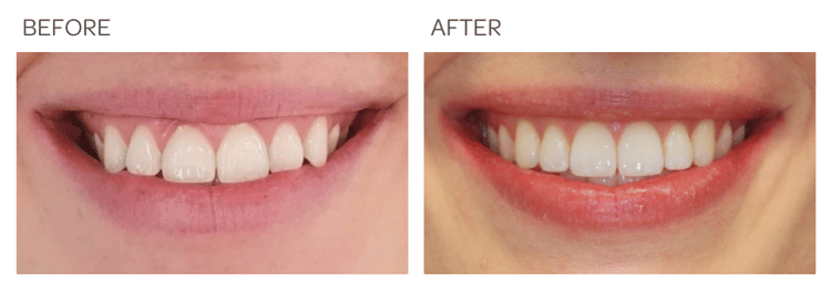 Invisalign to correct narrow crowder arches - SIA Dental