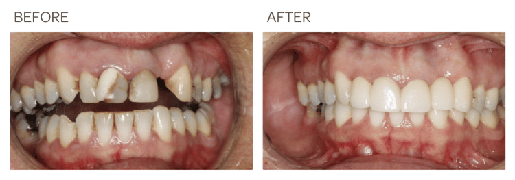 Removing decay and Improving smile with Crowns and Bridge - SIA Dental